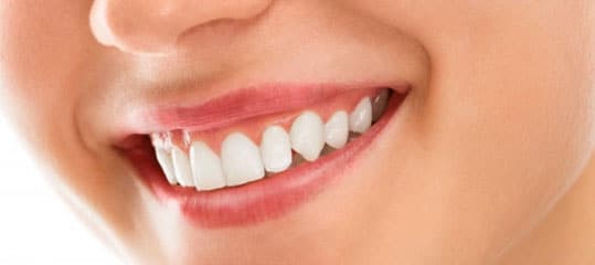 Smile Makeovers — Crestwood Family Dental In Molendinar, QLD