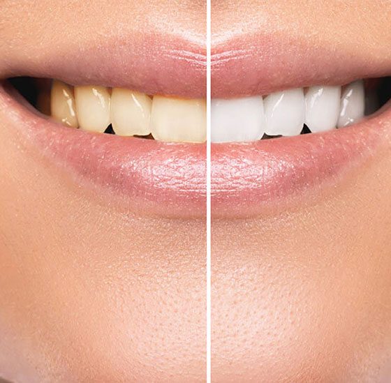 Before And After Teeth Whitening Procedure — Crestwood Family Dental In Molendinar, QLD