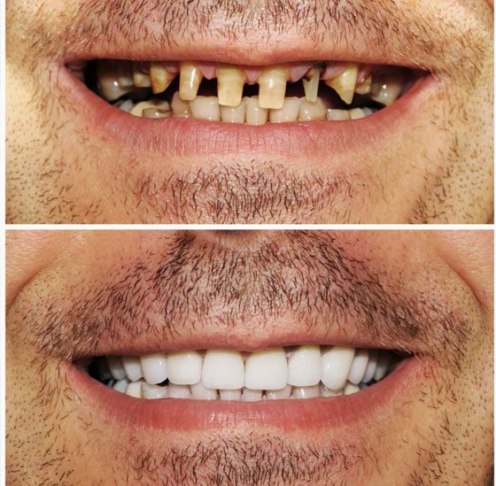 Before And After — Crestwood Family Dental In Molendinar, QLD