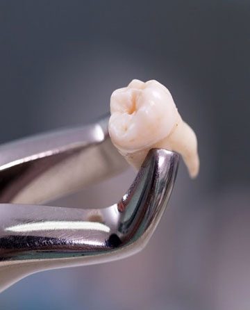 Dental Equipment Holding Extracted Tooth — Crestwood Family Dental In Molendinar, QLD