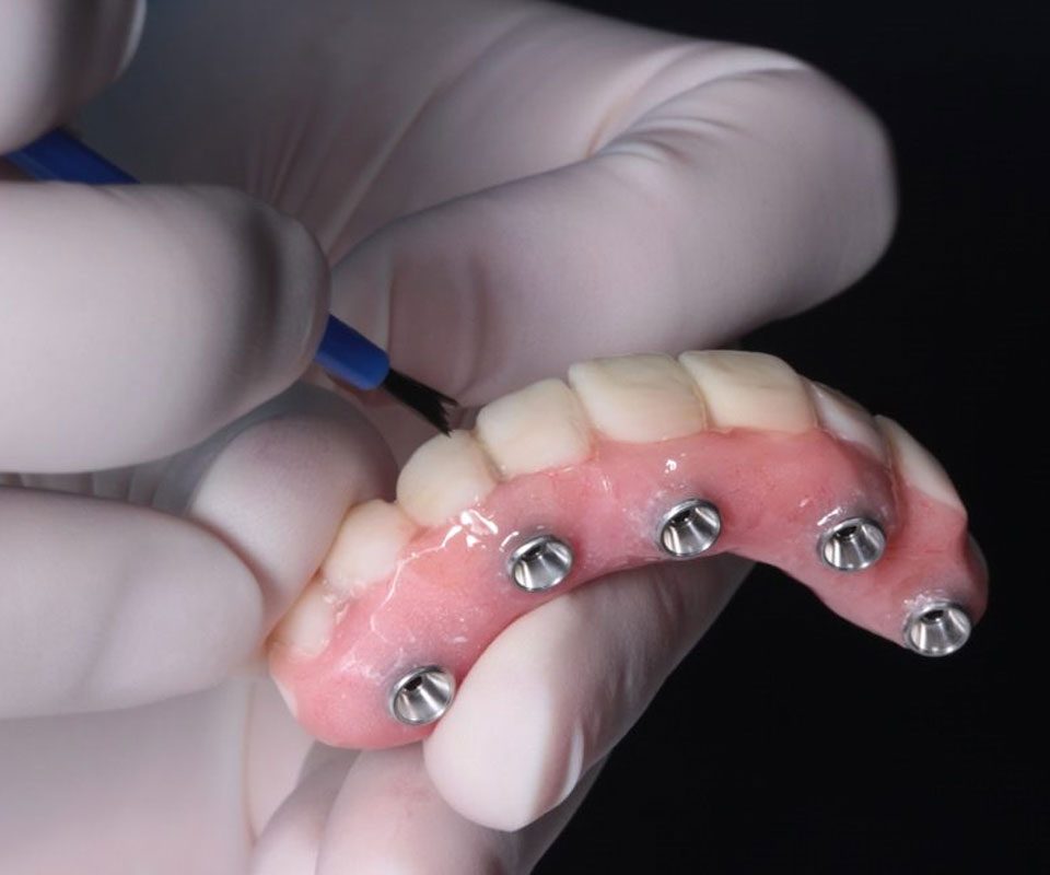 Dental Technician Glazing On 4 Dental Implants — Crestwood Family Dental In Molendinar, QLD