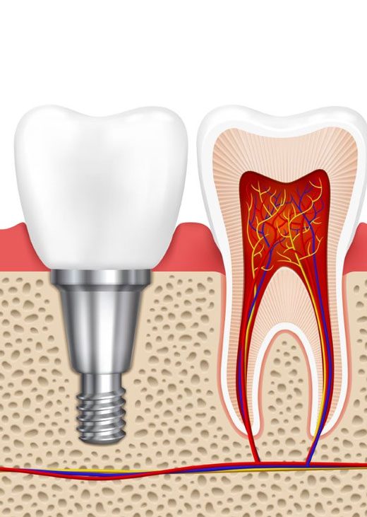 Healthy Teeth And Dental Implant — Crestwood Family Dental In Molendinar, QLD