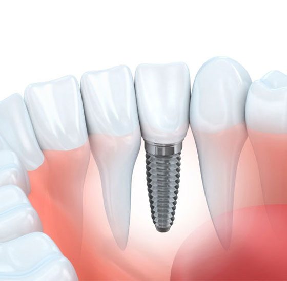 Tooth Implant — Crestwood Family Dental In Molendinar, QLD